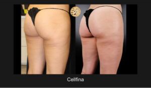 Cellulite Treatment